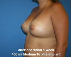 plastic-surgery-breast-augmentation